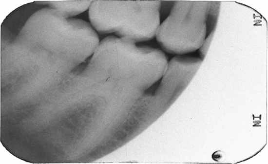 Dental Artifacts - Flashcards