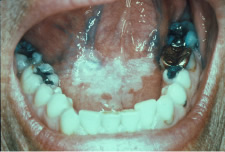 LEUKOPLAKIA - Flashcard